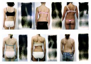 6 Women with Scoliosis and X-rays