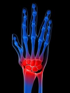Arthritis in the Hand - Rheumatoid