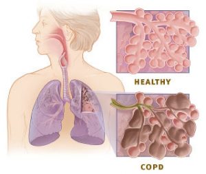 Healthy and COPD Lung Diagram